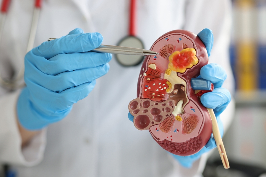 Chronic kidney disease early signs and prevention