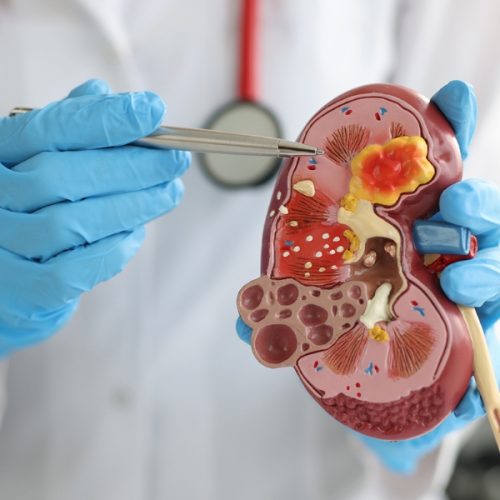 Chronic kidney disease early signs and prevention